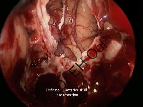 Endoscopic anterior skull base resection