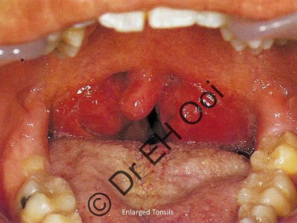 Enlarged Tonsils