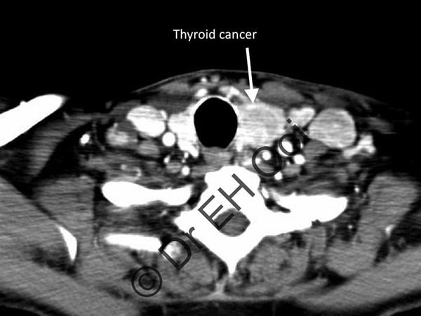 Adelaide ENT Surgery Thyroid Cancer